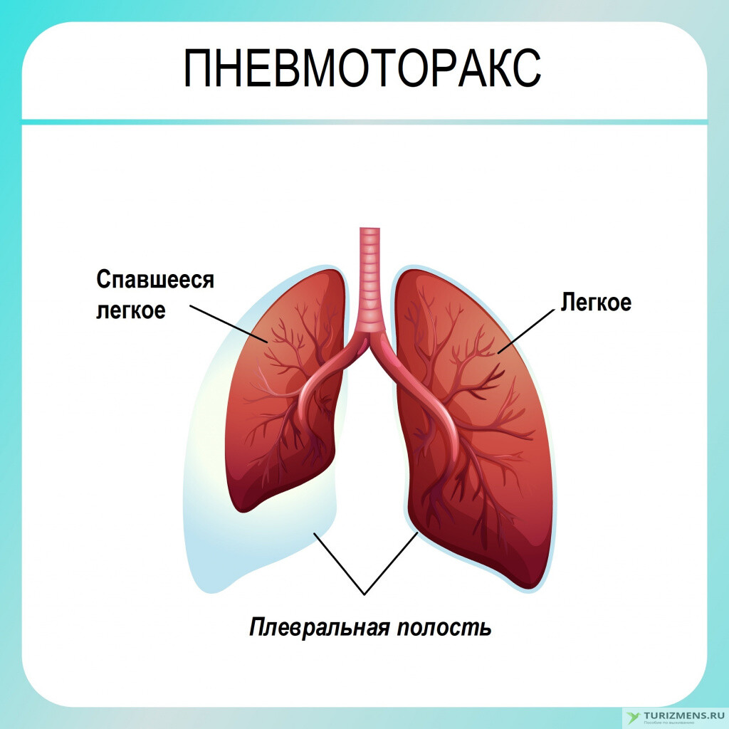 Физикальная картина при пневмотораксе характеризуется